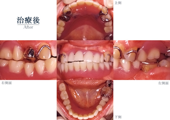 義歯001アフター