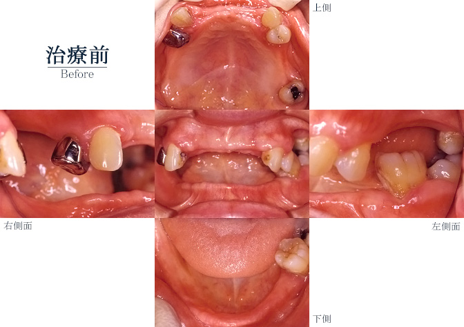 義歯001ビフォー