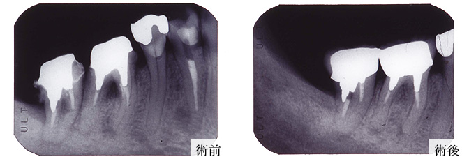 歯周再生写真01