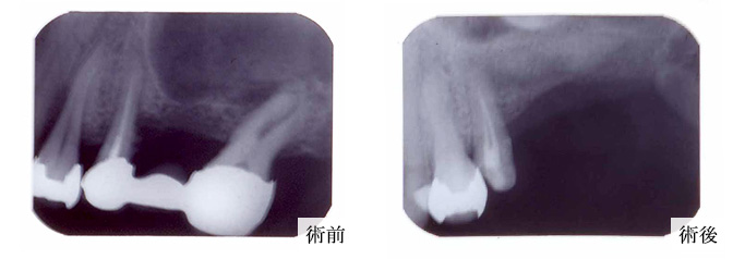 歯周再生写真02