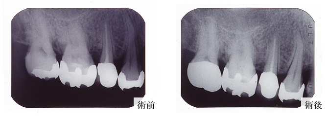 歯周再生写真03