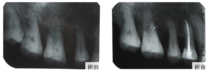 歯周再生写真04