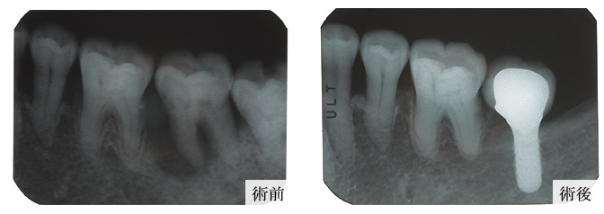 歯周再生写真06