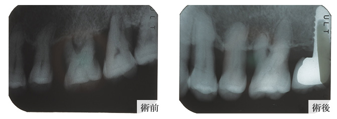 歯周再生写真07