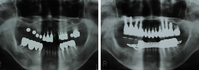 インプラント前後のレントゲン