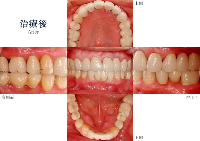 オーラルリハビリテーション002アフター