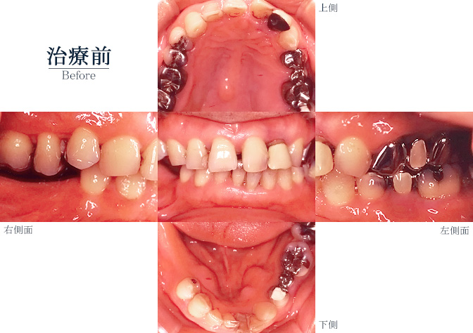 オーラルリハビリテーション002ビフォー