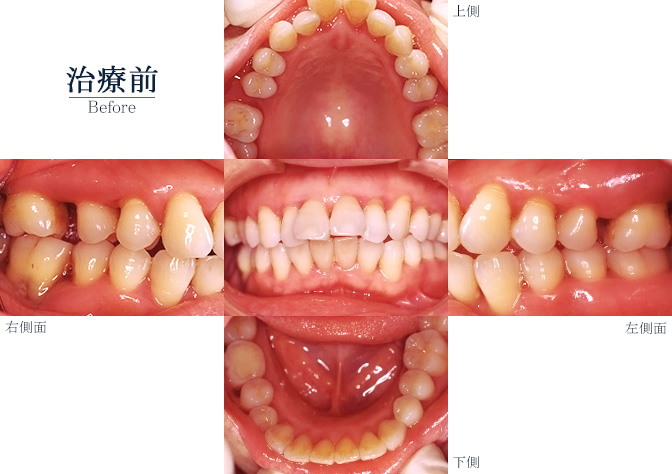 歯周病症例001ビフォー