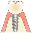 インプラントイメージ